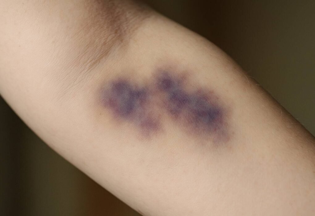 Upptäck det överraskande sambandet mellan stress och blåmärken. Lär dig om mekanismerna bakom, riskfaktorer och effektiva naturliga behandlingar.