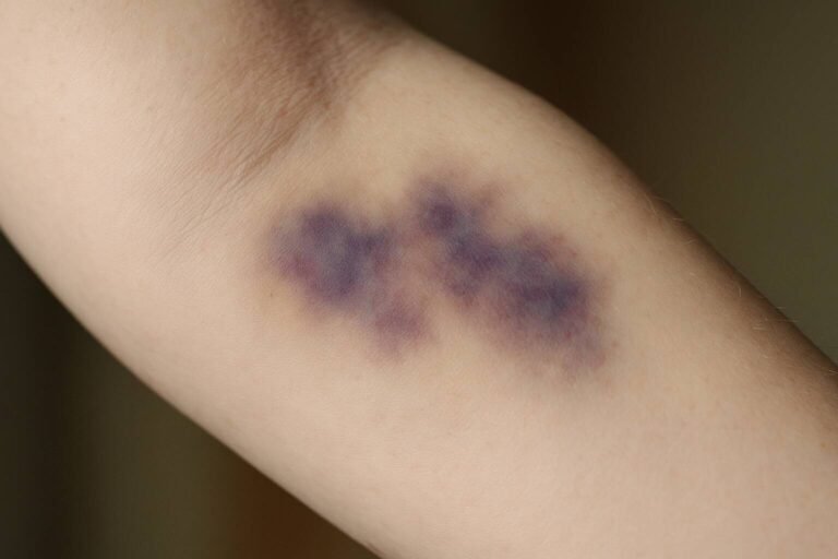 Upptäck det överraskande sambandet mellan stress och blåmärken. Lär dig om mekanismerna bakom, riskfaktorer och effektiva naturliga behandlingar.